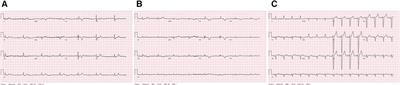 Case Report: Complete atrioventricular block in an elderly patient with acute pulmonary embolism